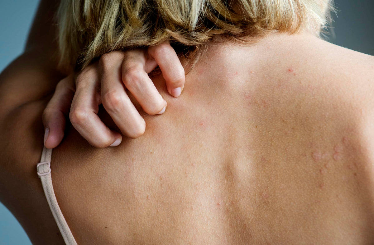 7 Keys to Controlling Psoriasis and How to Reverse It