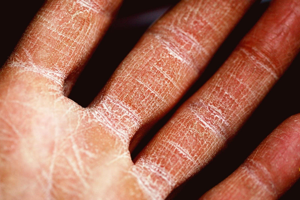 Eczema: Causes, Symptoms & Remedies