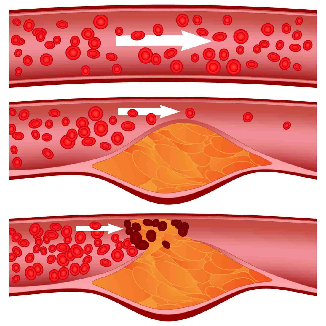 How To Unclog Arteries [2 Simple Steps]