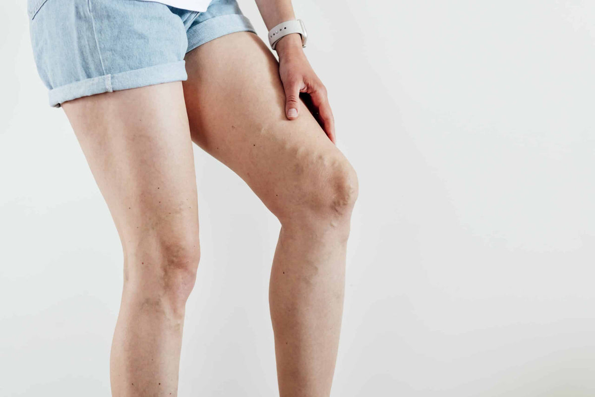 Varicose Veins & Swollen Ankles [3 Natural Solutions]