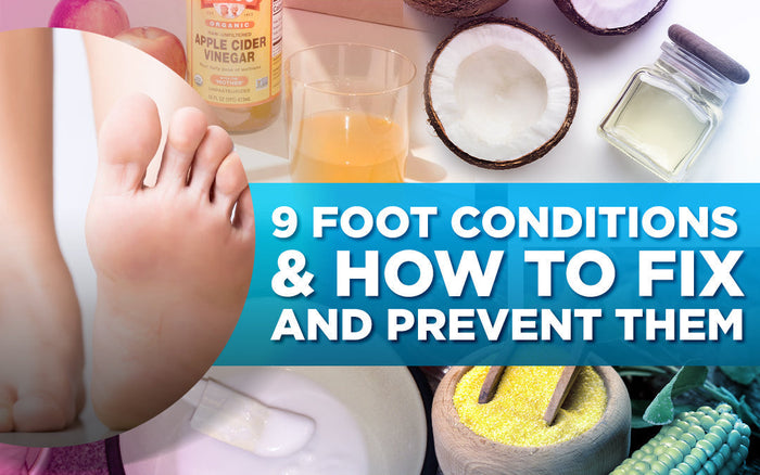 "Image with text: '9 Foot Conditions & How to Fix and Prevent Them,' showing feet and natural remedies."