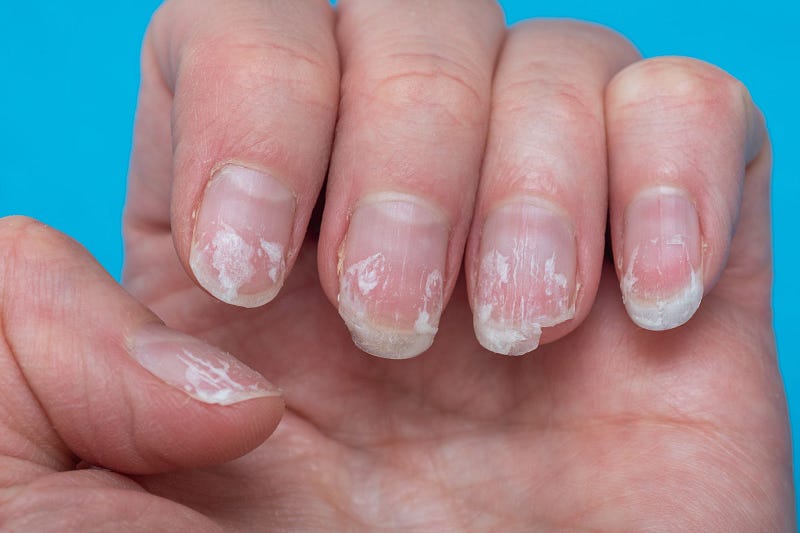 What Your Nails Are Trying to Tell You About Your Health