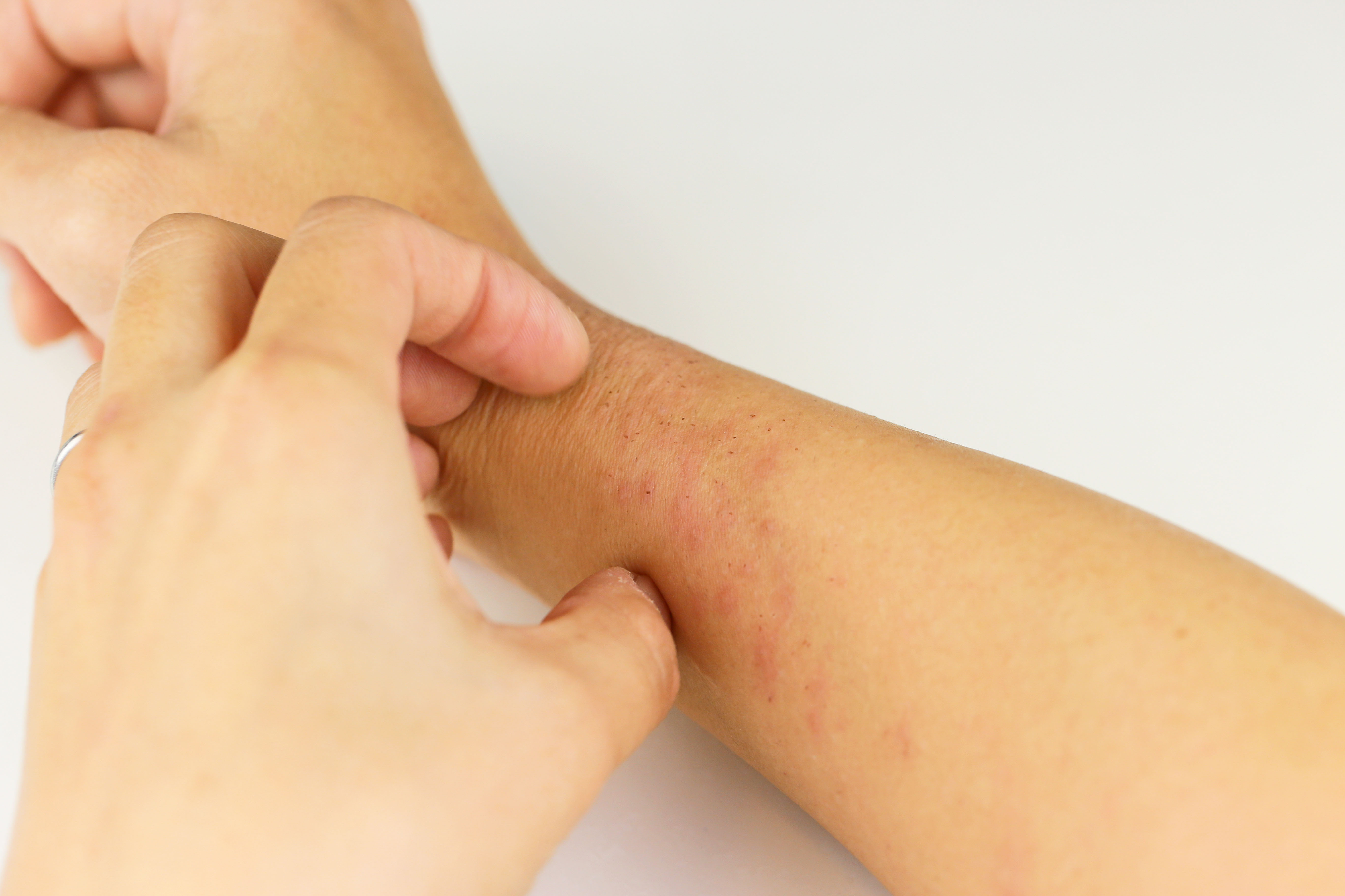 skin rashes that itch only on hand