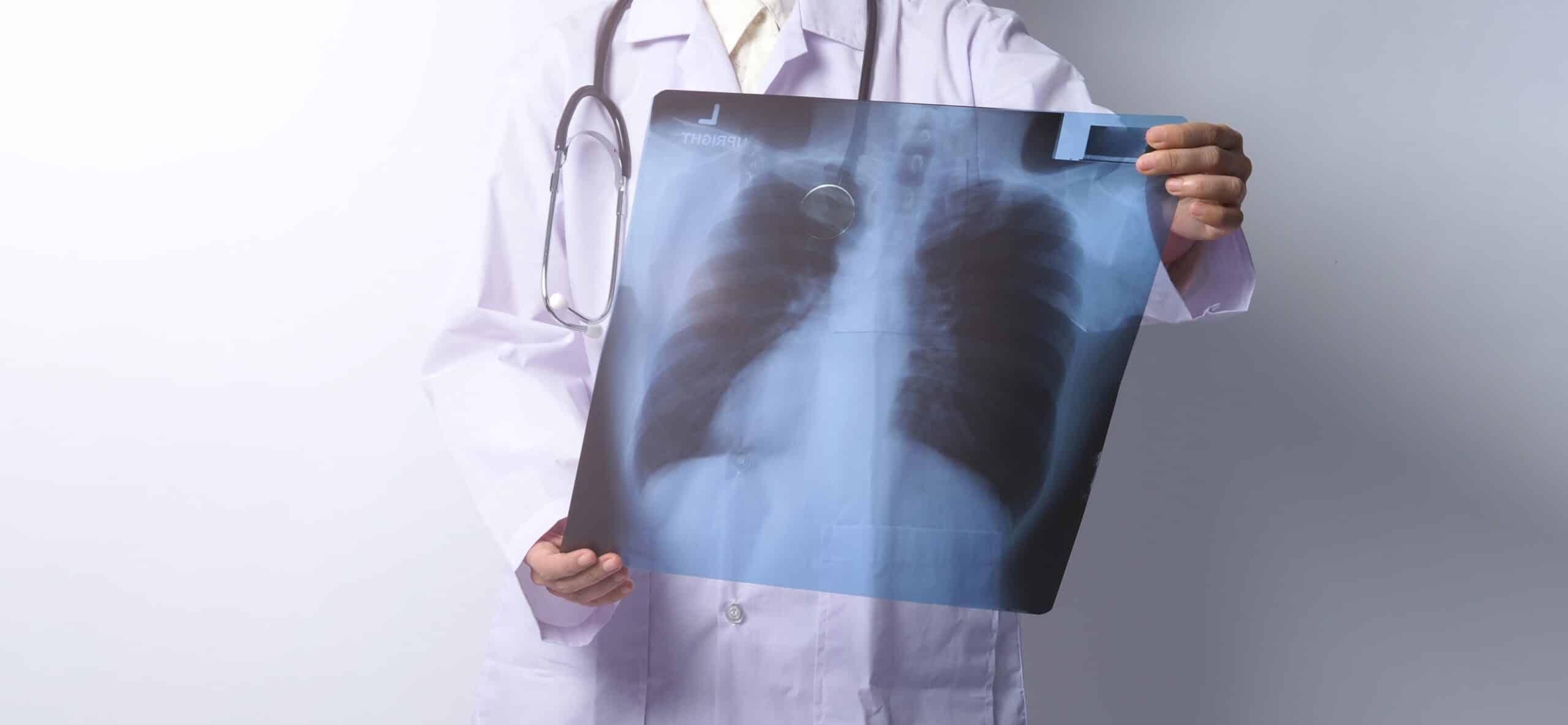 Doctor holding and checking up lung’s x-ray film